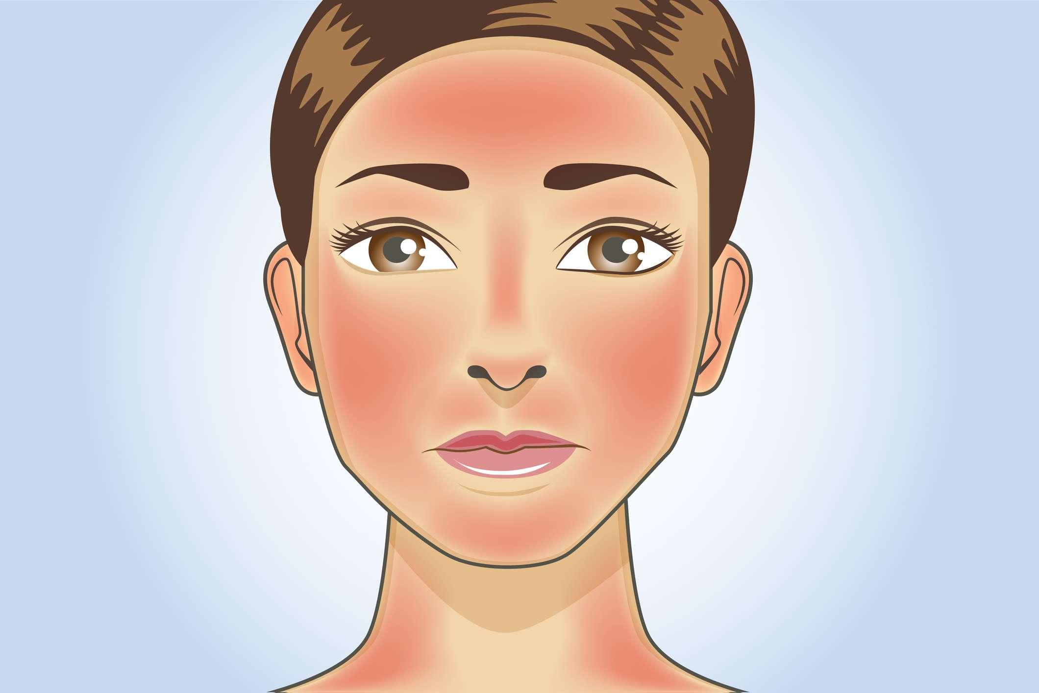 Hautrötungen erscheinen auf Gesicht und Hals der Frau durch Sonnenbrand. Illustration über die Gefahr von ultravioletter Strahlung.