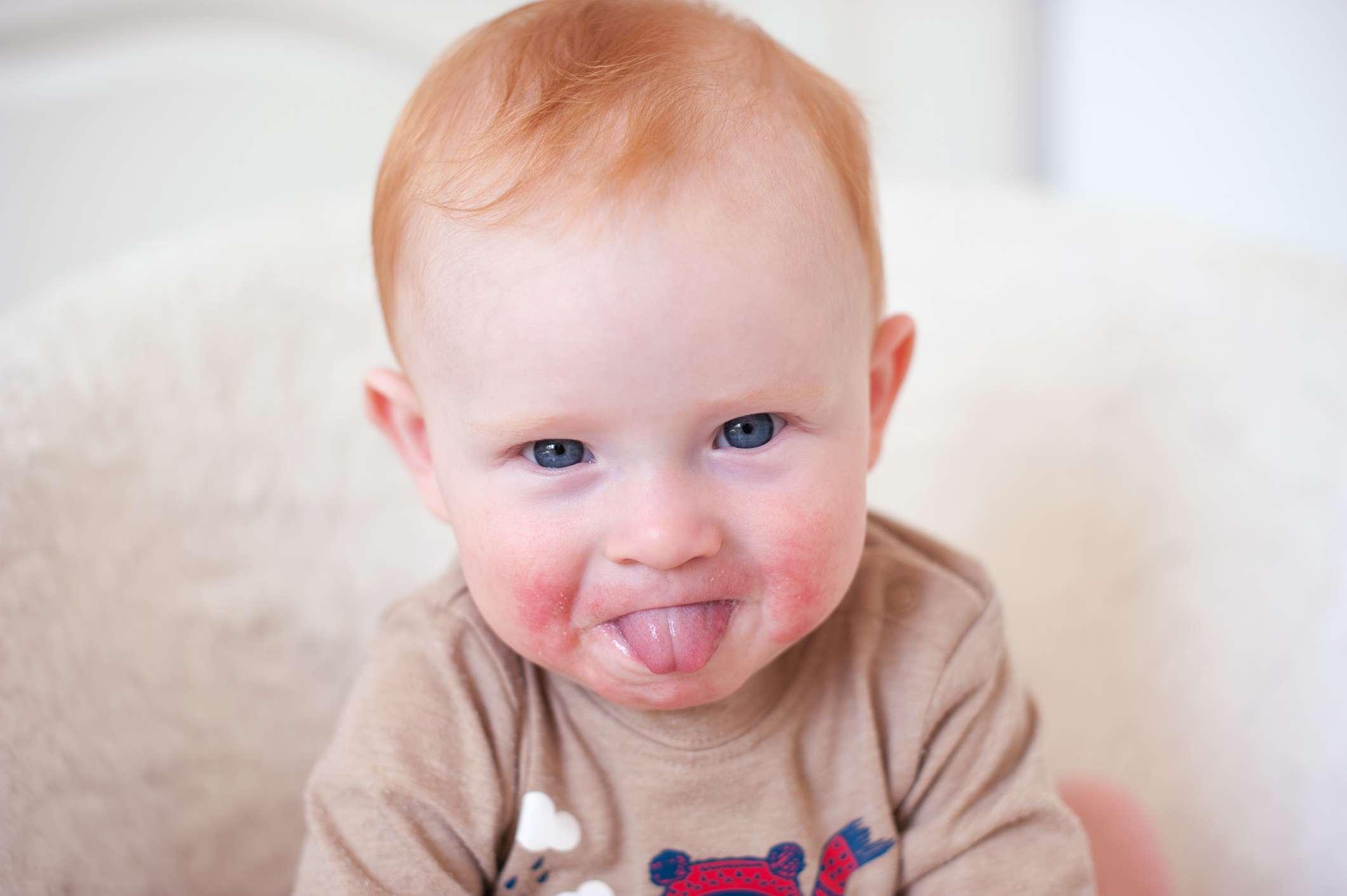 Ein Kind mit einer Allergie im Gesicht zeigt seine Zunge