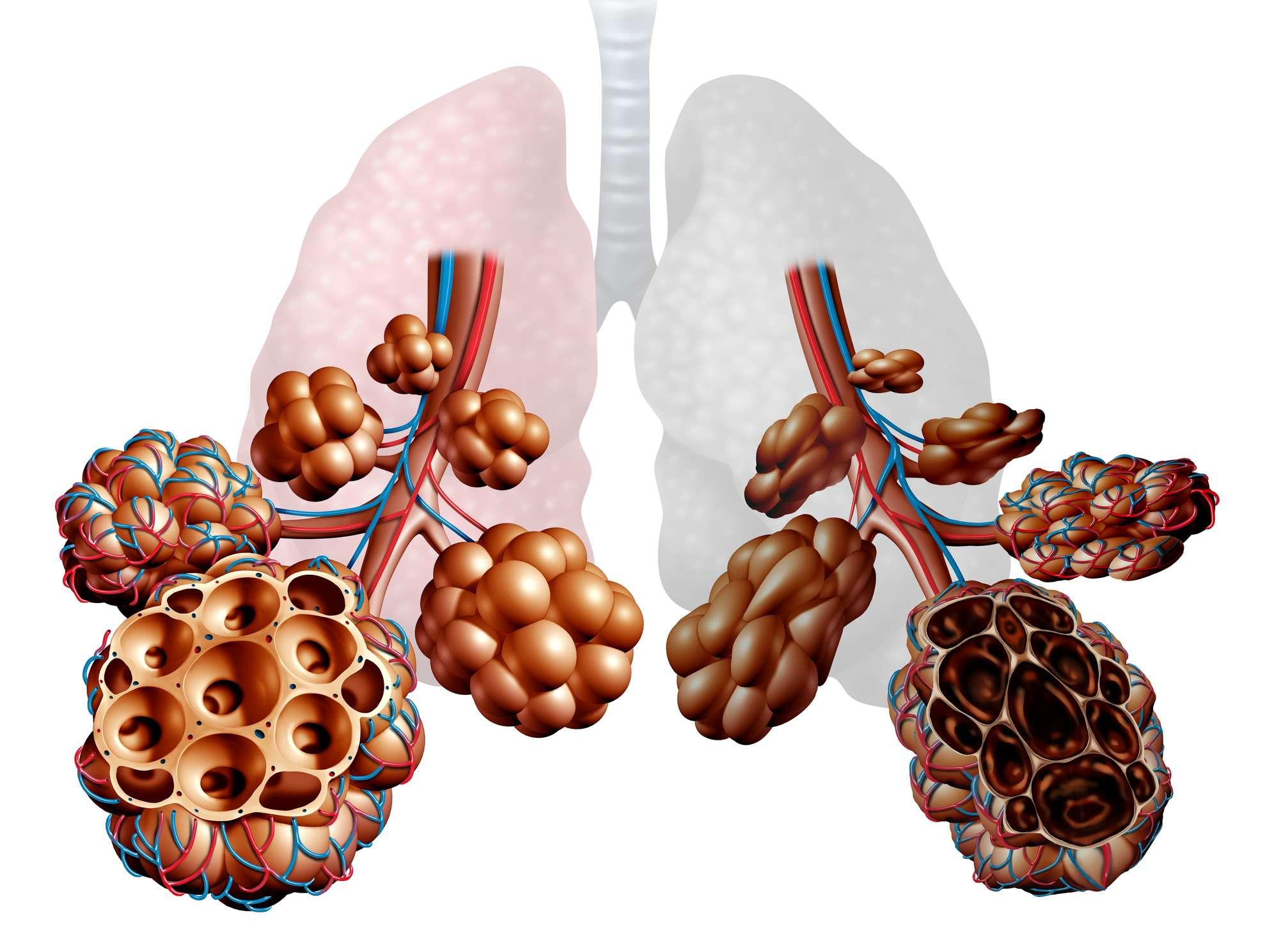 Emphysem-Krankheit