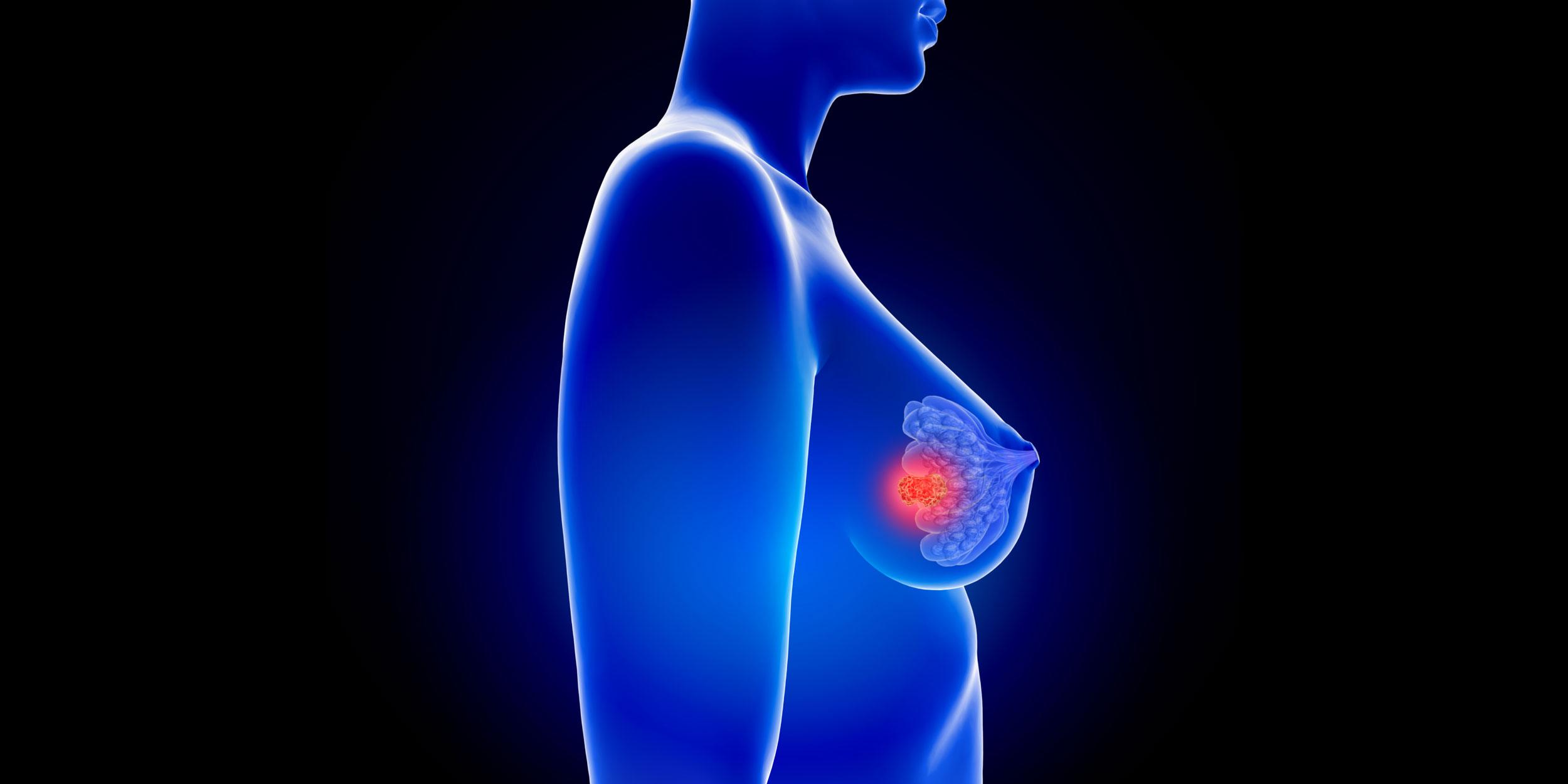 3D-Darstellung der weiblichen Brustanatomie mit Brustkrebszellen - Mammakarzinom