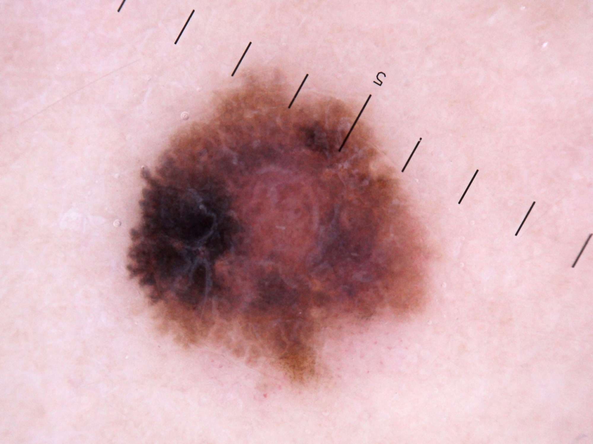 Lebensgroße und Dermatoskopfotos von Melanomen