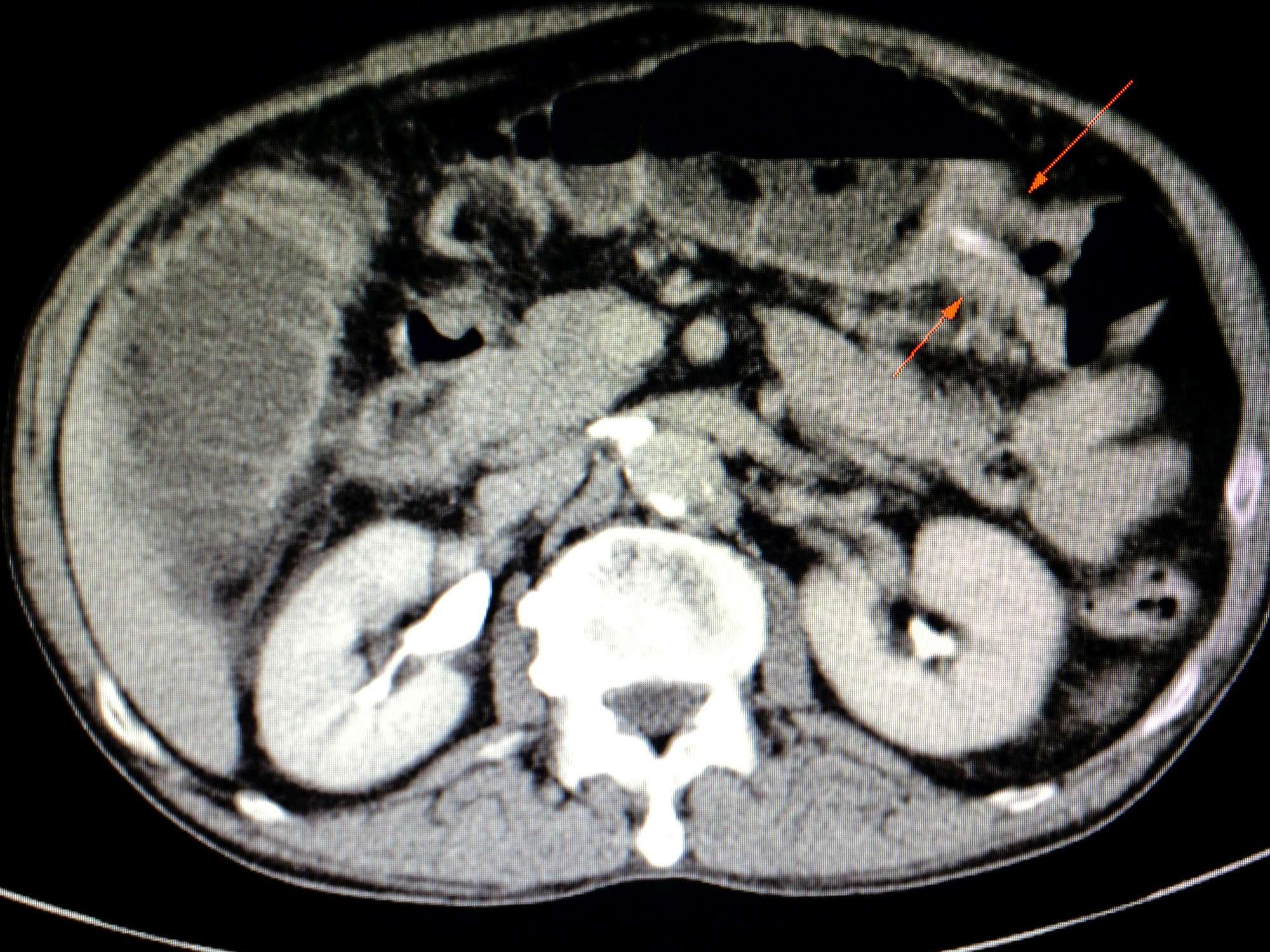 ein Computertomographie (CT)-Scan eines Patienten mit Karzinom in seinem Querkolon