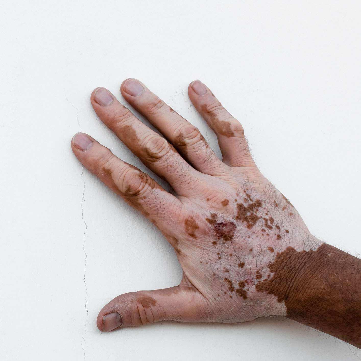 Die Hand des Mannes ist von Vitiligo betroffen, isoliert auf weißem Hintergrund