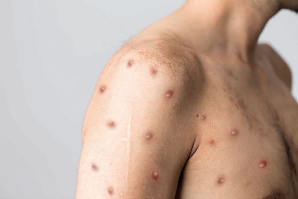 Monkeypox neue Krankheit gefährlich auf der ganzen Welt. Foto in hoher Qualität