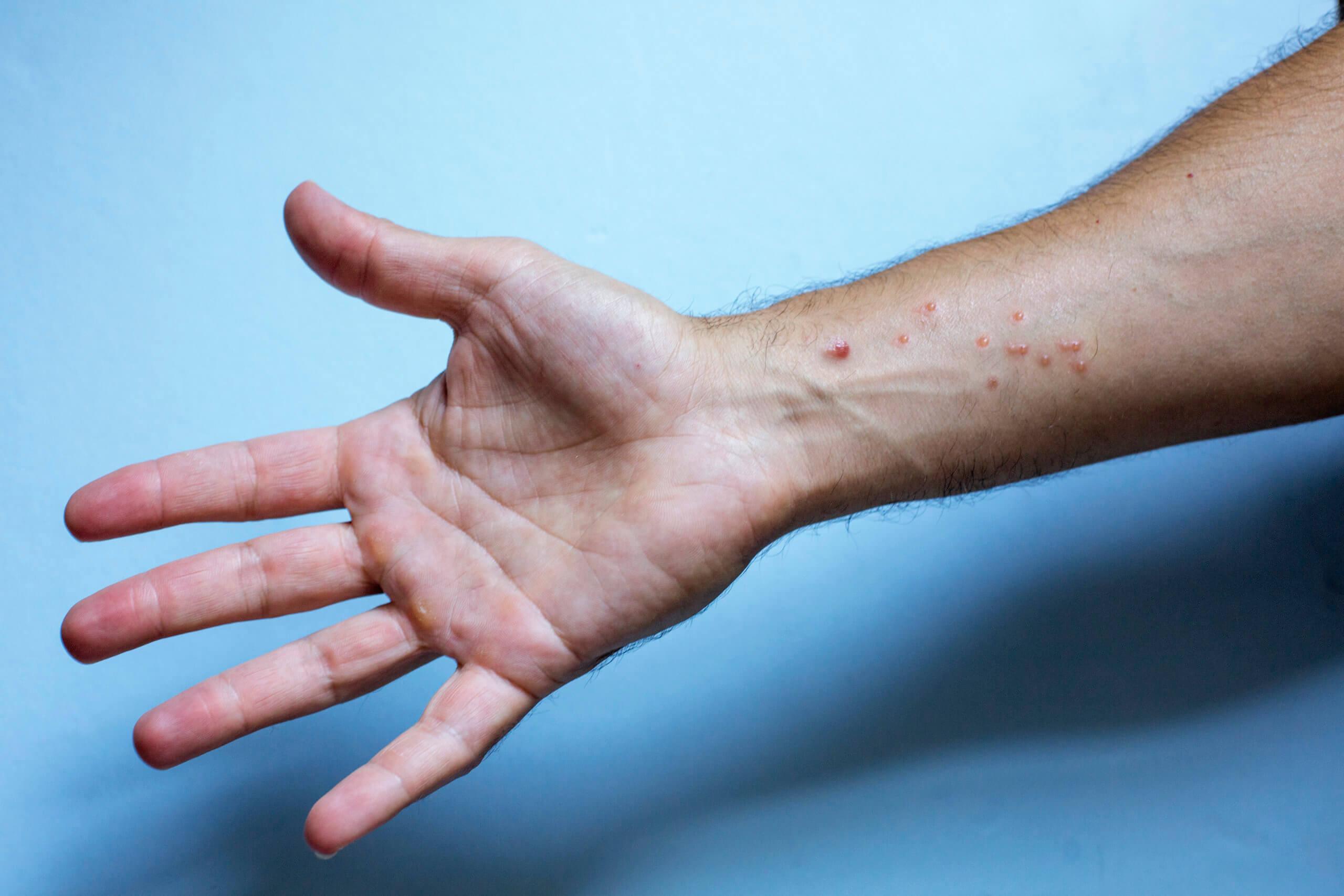 Unterarm eines Mannes mit Hautausschlag.Monkeypox-Virus-Symptome