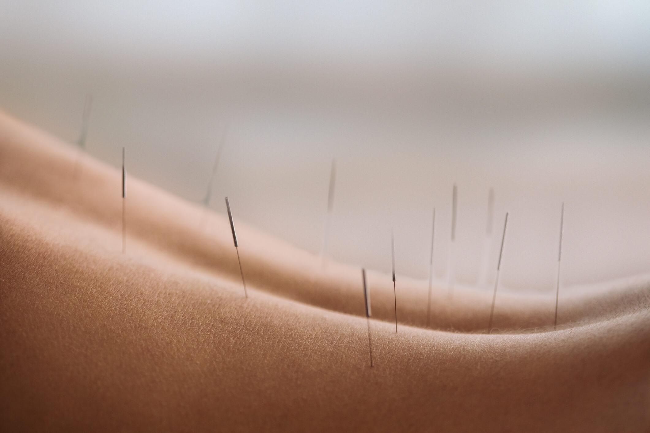 Rückenbehandlung mit Akupunktur
