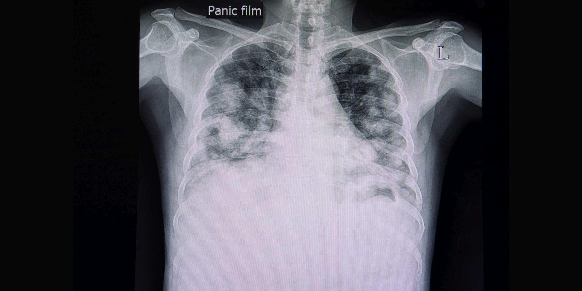 Ein Röntgenfilm des Brustkorbs eines Patienten mit metastasierendem Karzinom in beiden Lungen. Es wurde ein großes hepatozelluläres Karzinom gefunden.