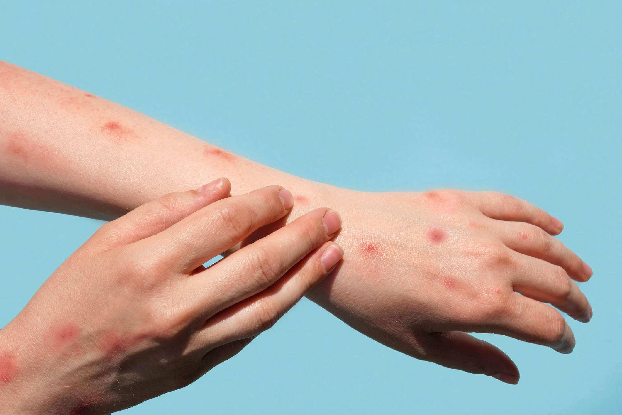 Monkeypox neue Krankheit gefährlich auf der ganzen Welt. Patient mit Affenpocken. Schmerzhafter Ausschlag, rote Flecken, Blasen an der Hand. Nahaufnahme Hautausschlag, menschliche Hände mit Gesundheitsproblem. Banner, Kopierbereich.