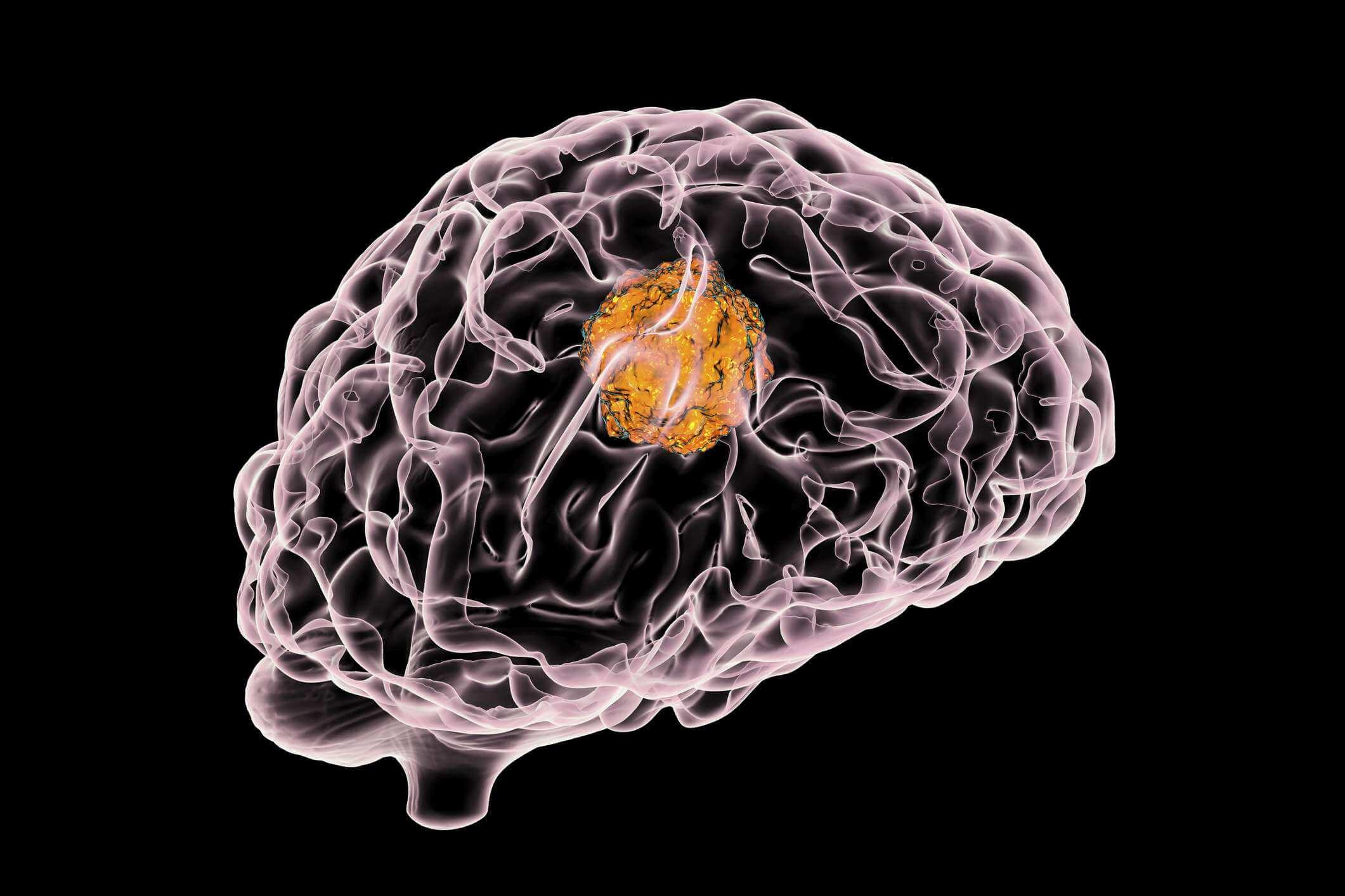 Hirntumor, 3D-Darstellung, die das Vorhandensein eines Tumors im Gehirn zeigt
