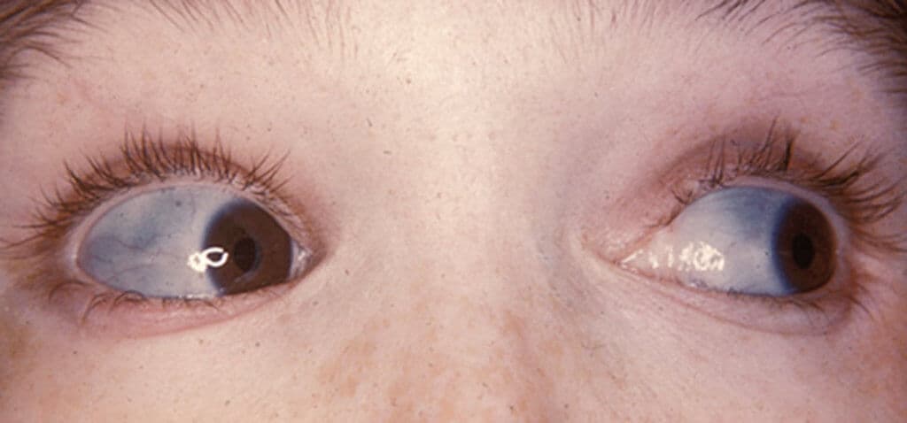 MO_AT_2023_KW10_mtnl_MTCH_2023_04_S06wiki_Characteristically_blue_sclerae_of_patient_with_osteogenesis_imperfecta