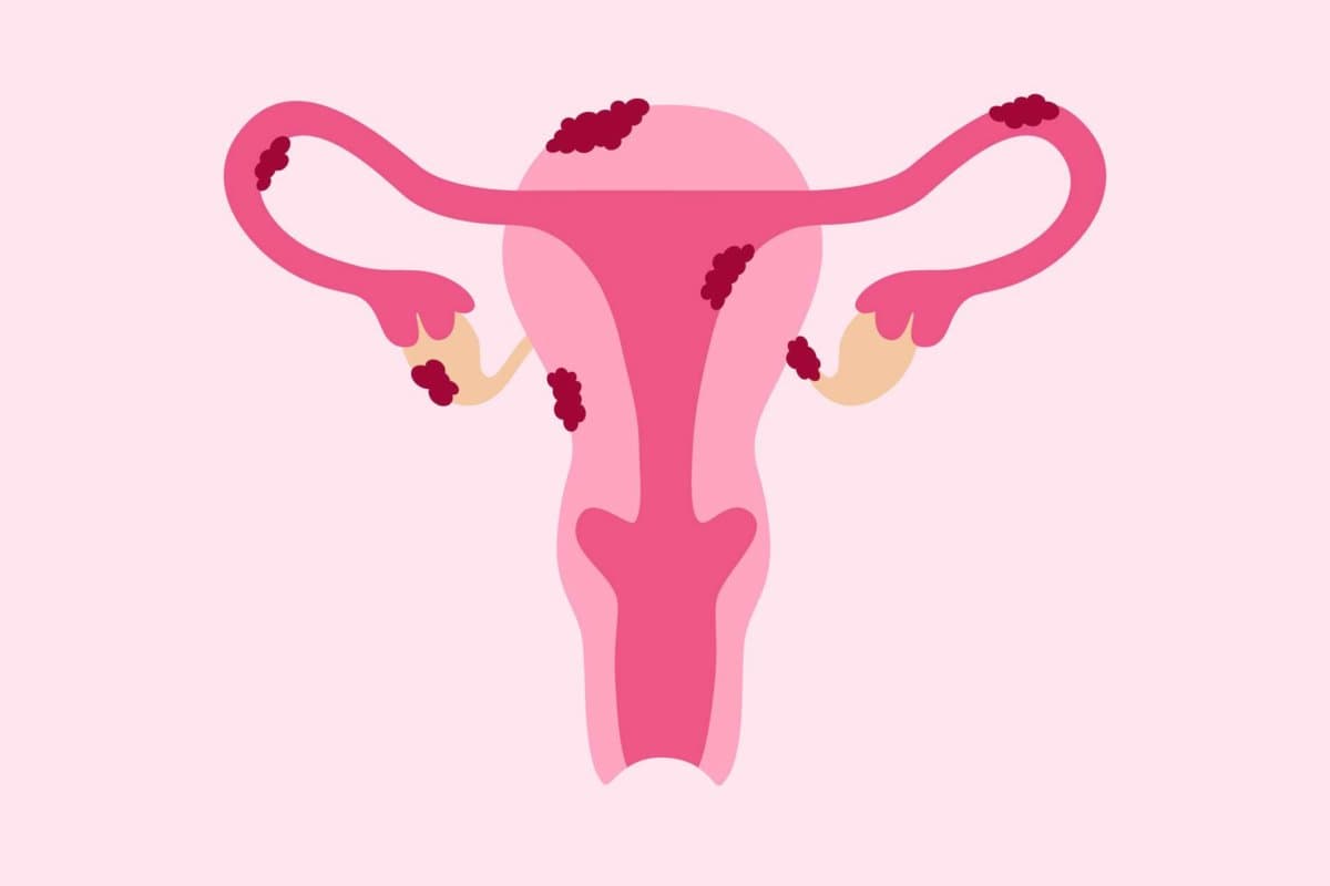 Endometriose-Krankheit. Gebärmutter mit Gewebewachstum