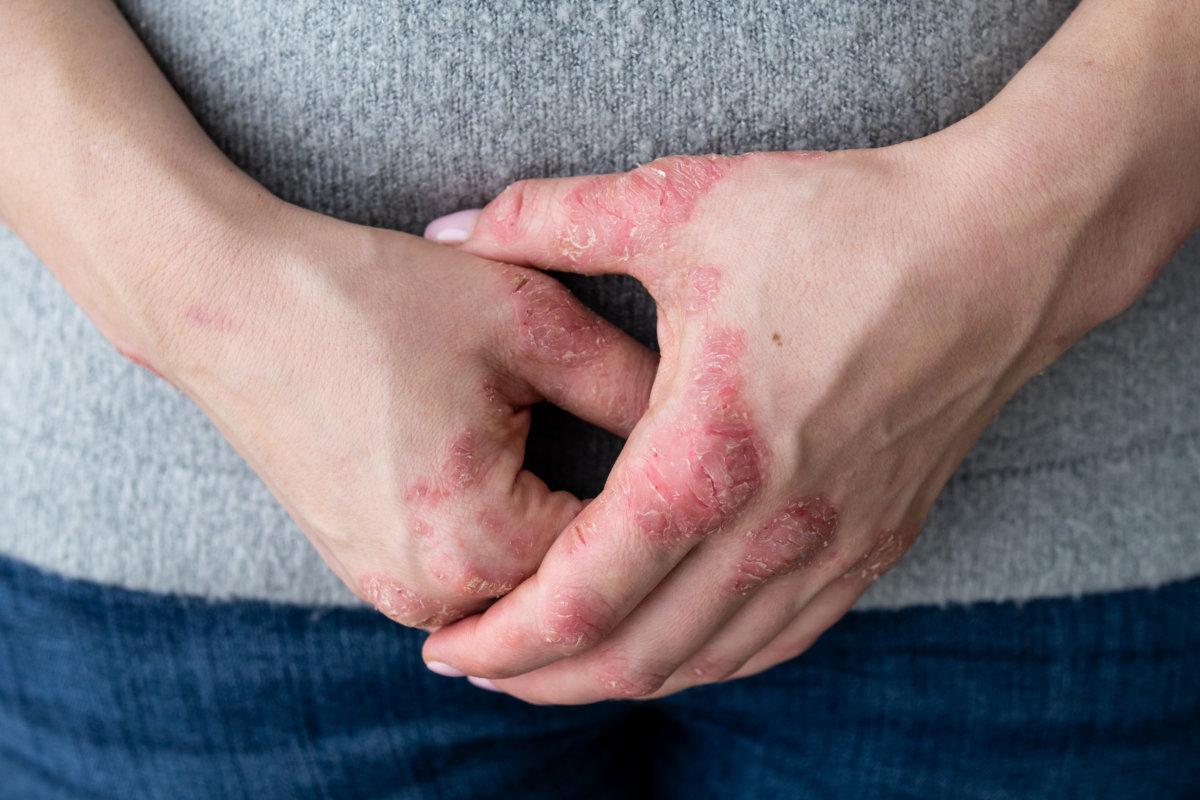 Cracked, flaky skin on the palm of your hand. Dermatological problems of psoriasis. Hard, horny and cracked skin on the finger in a man&#8217;s hand. Psoriasis, allergy