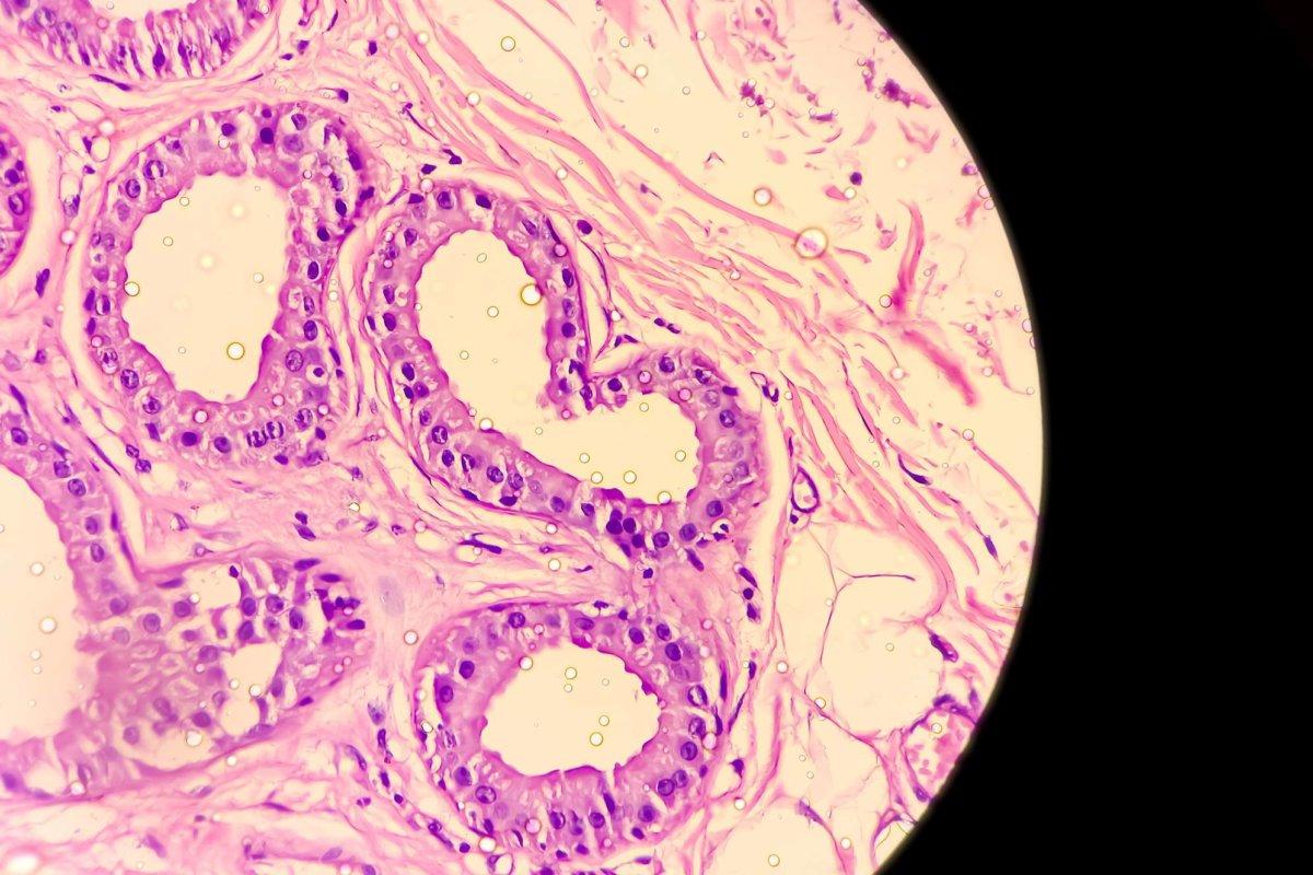 Mikroskopisches Bild von Hidradenitis suppurativa im axillären Massengewebe. Zeigt eine Hyperplasie des Follikelepithels und ein Infiltrat dermaler Entzündungszellen