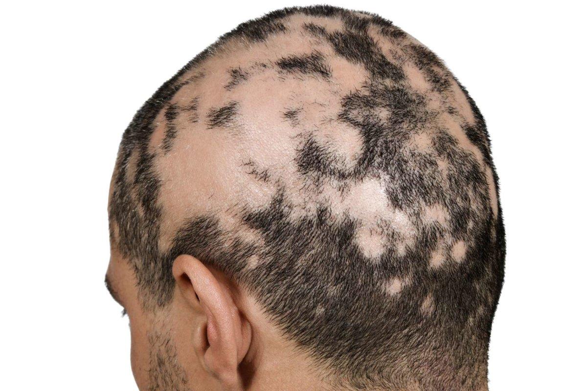 Alopecia areata: investigativer JAK-Hemmer führt zu deutlichem Haarwuchs