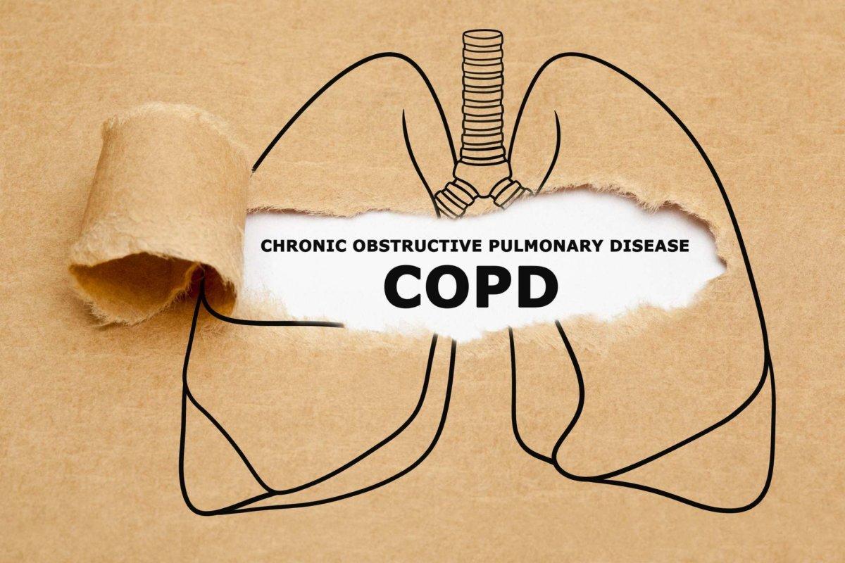 Text „Chronisch obstruktive Lungenerkrankung COPD“ erscheint hinter zerrissenem braunem Papier in einer Zeichnung der menschlichen Lunge.