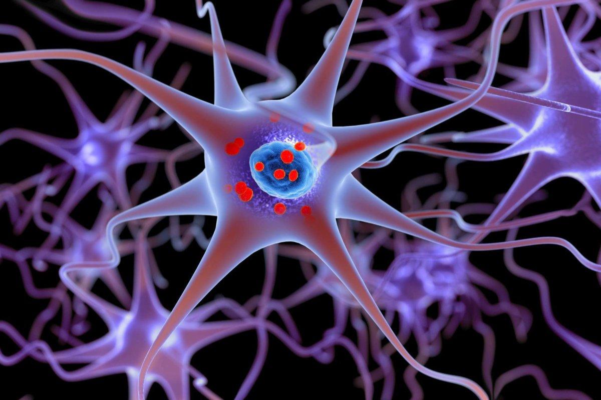 Parkinson-Krankheit. 3D-Darstellung, die Neuronen zeigt, die kleine rote Lewy-Körperchen enthalten, bei denen es sich um Ablagerungen von Proteinen (Alpha-Synuclein) handelt, die sich in den Gehirnzellen angesammelt haben.