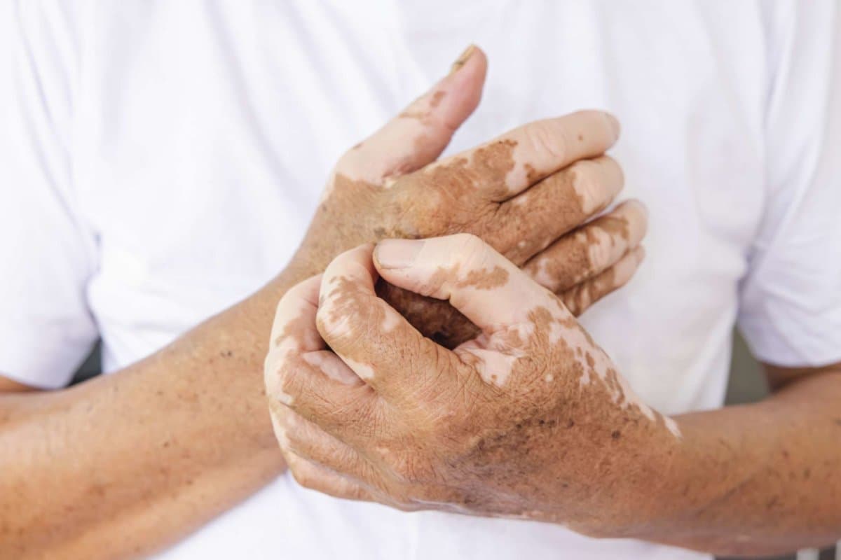 Nahaufnahme von Vitiligo auf der Haut der Hände alter Menschen. medizinischer Zustand, der zur Depigmentierung von Hautstellen führt.