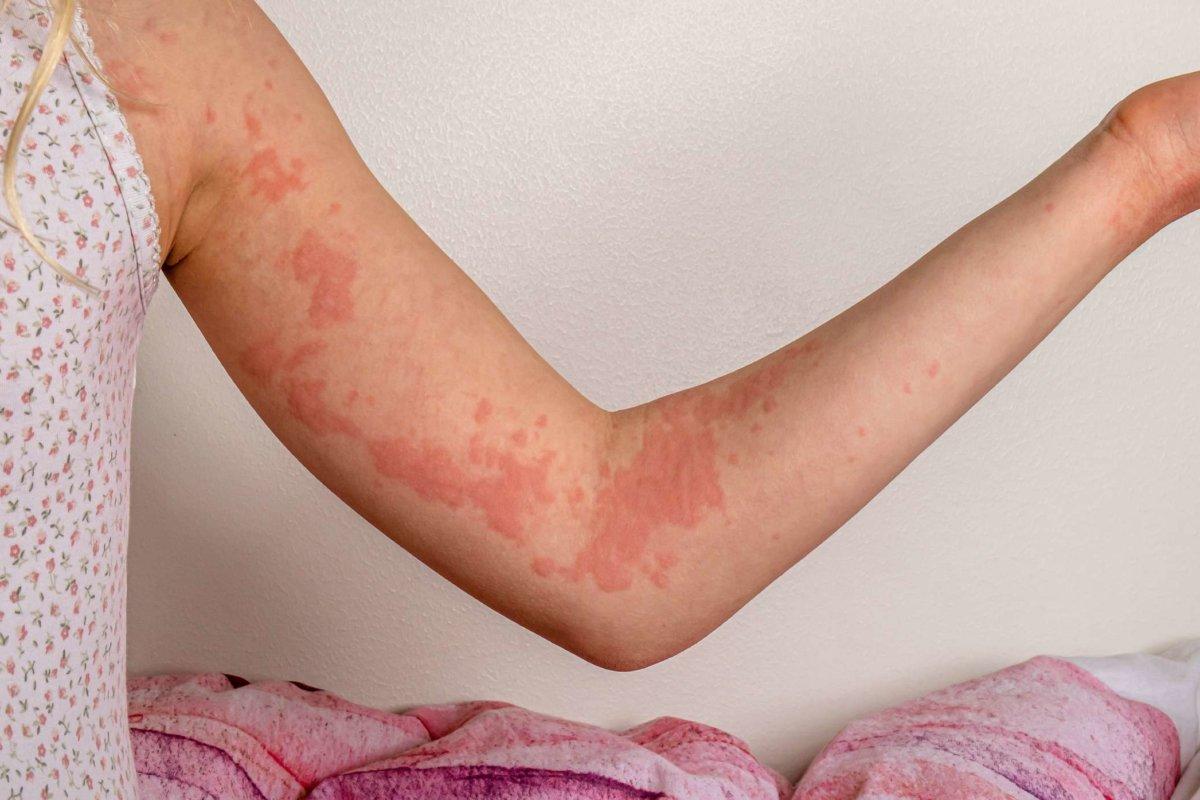 Der Arm eines Mädchens mit Urtikaria-Hautläsionen (Nesselsucht). Mädchen sitzt auf einem Bett und trägt ein ärmelloses Oberteil.