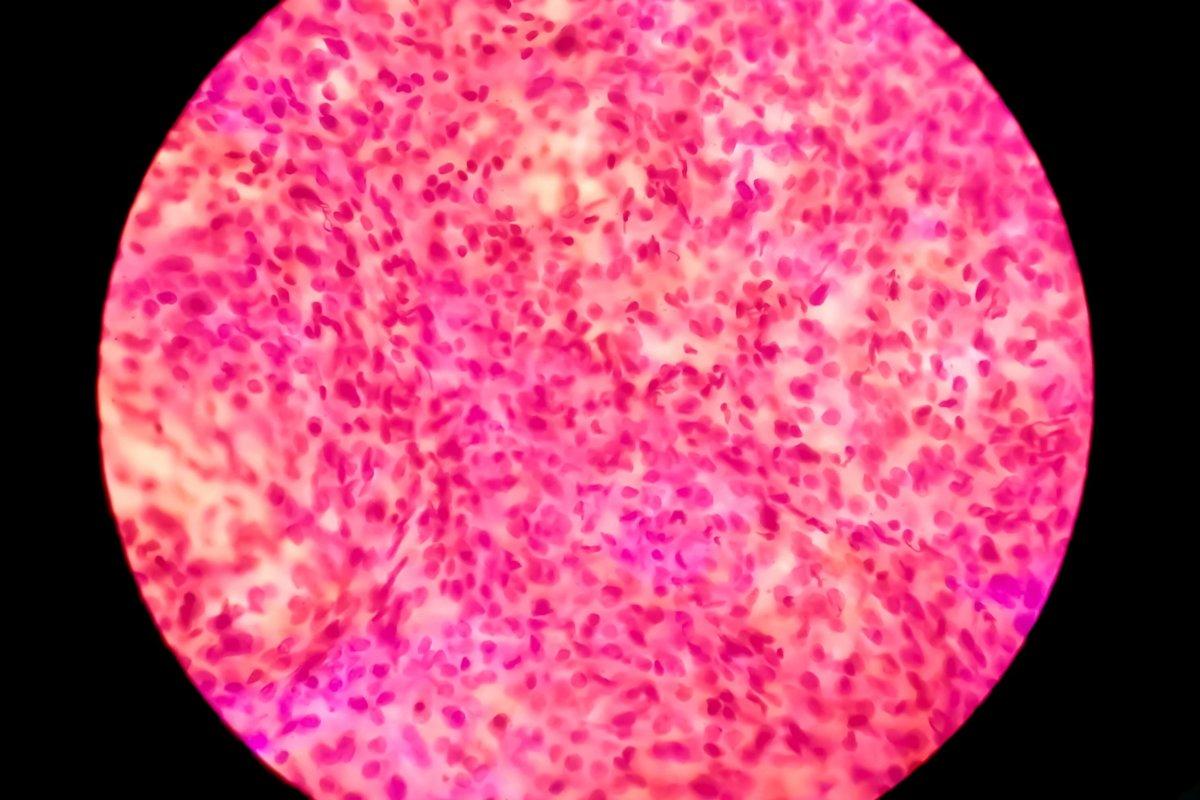Nierenkrebs: Mikroskopisches Bild eines Klarzellkarzinoms, der häufigsten Art von Nierenzellkarzinom, das durch zytoplasmatische Clearing und ein Muster kleiner verzweigter Blutgefäße gekennzeichnet ist.