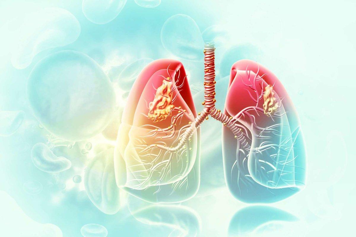 Medizinische Illustration, die Lungenkrebs oder Bronchialkarzinom zeigt. 3D-Illustration