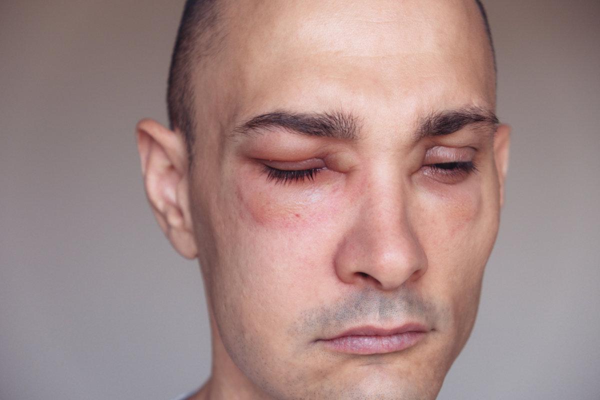Ein kaukasischer Mann hat ein Angioödem um die Augen, das durch eine allergische Reaktion auf Stoffe wie Insektenstiche, Nahrungsmittel oder Medikamente verursacht wird. Geschwollenes Gesicht, Nahaufnahme.