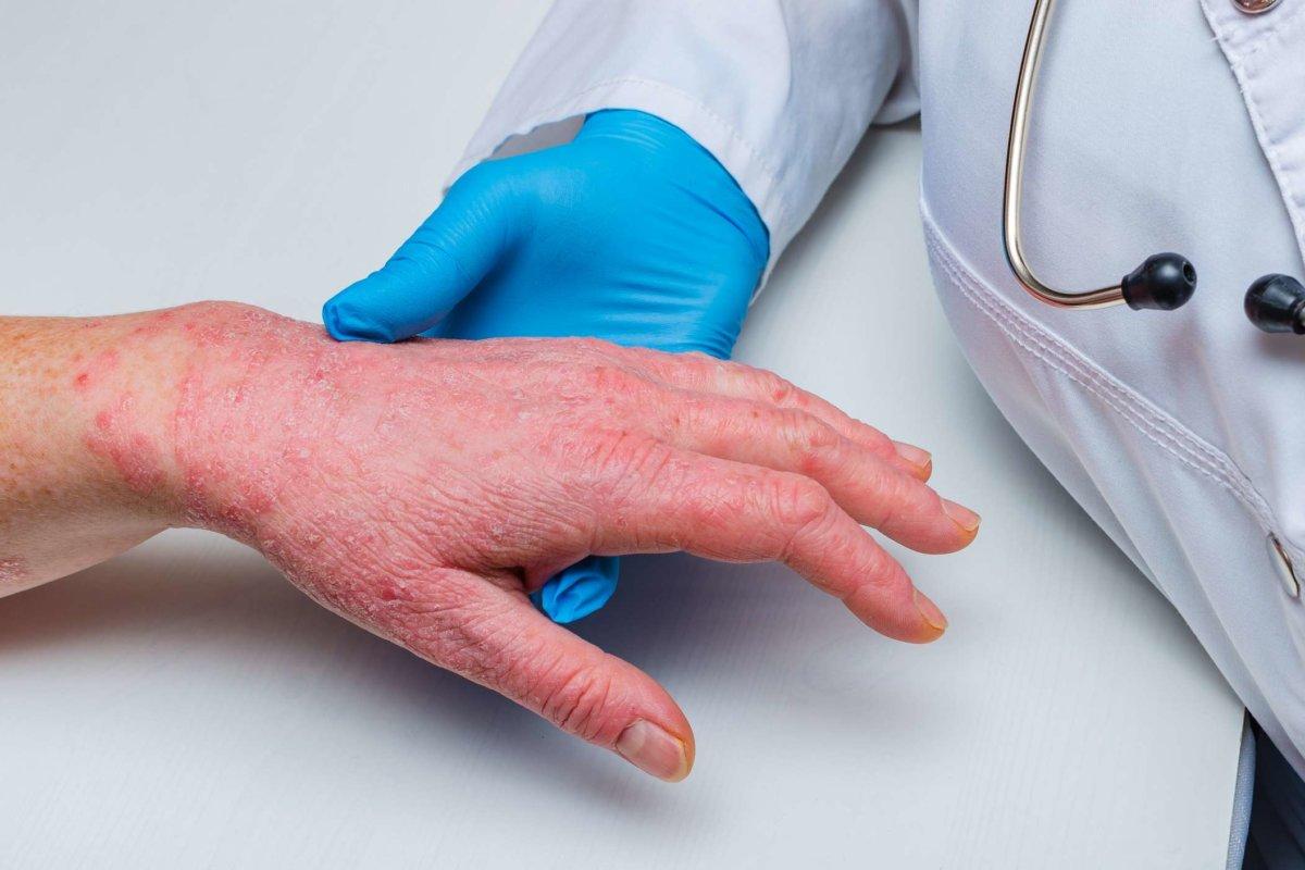 Arzt in Handschuhen untersucht die Haut der Hand eines kranken Patienten. Chronische Hauterkrankungen – Psoriasis, Ekzeme, Dermatitis.