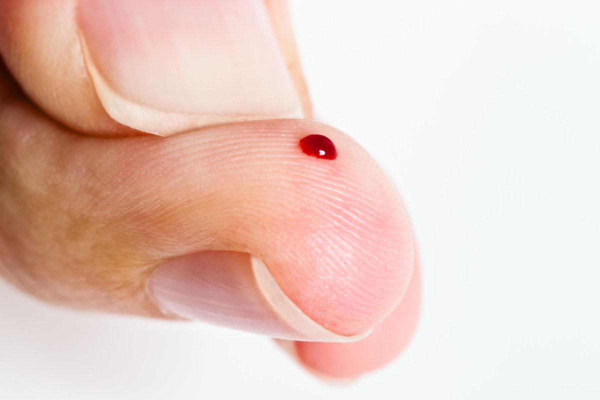 „Nahaufnahme eines Daumens, der einen Blutstropfen aus einem Finger drückt, wahrscheinlich für eine Blutuntersuchung.“