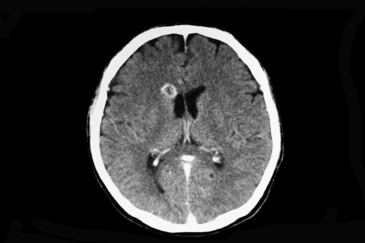 CT-Gehirnscan eines Patienten mit Abszess im Gehirn