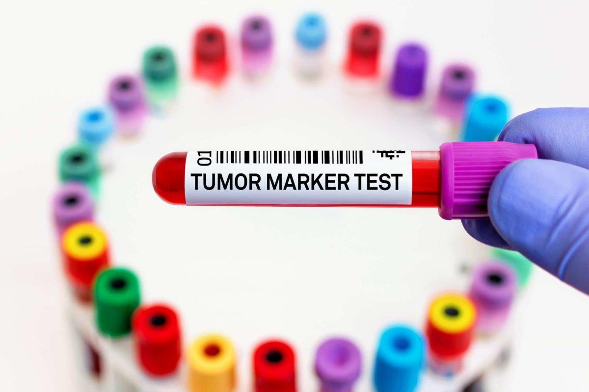 Arzt mit Blutröhrchen beschriftet mit Tumormarker zur Analyse des Krebs-Biomarker-Tests