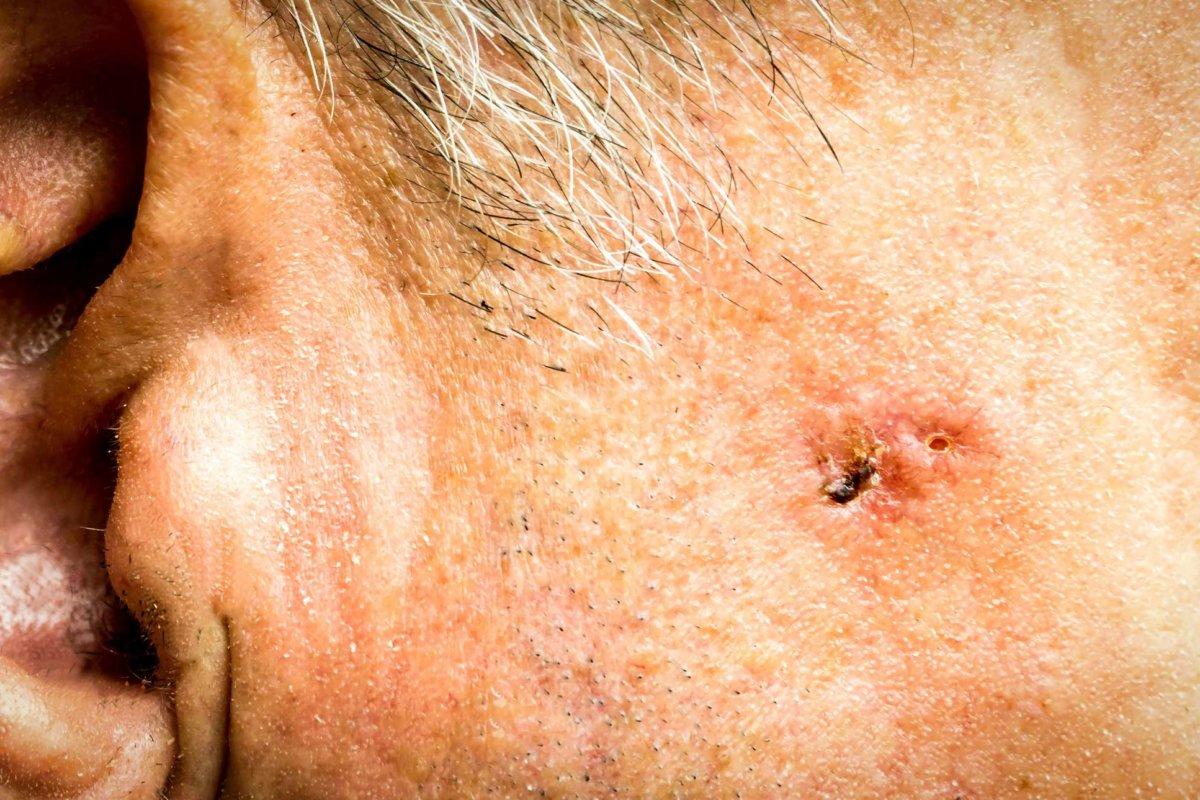 Basalzellkarzinom im Gesicht eines älteren Mannes vor der Operation &#8211; Nahaufnahme