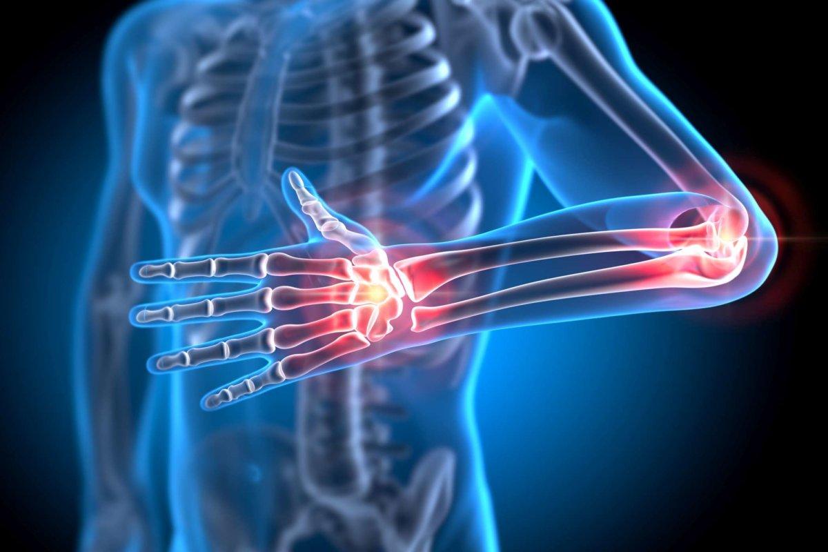 Röntgendarstellung eines schmerzhaften Hand- und Ellenbogengelenks – medizinische 3D-Illustration