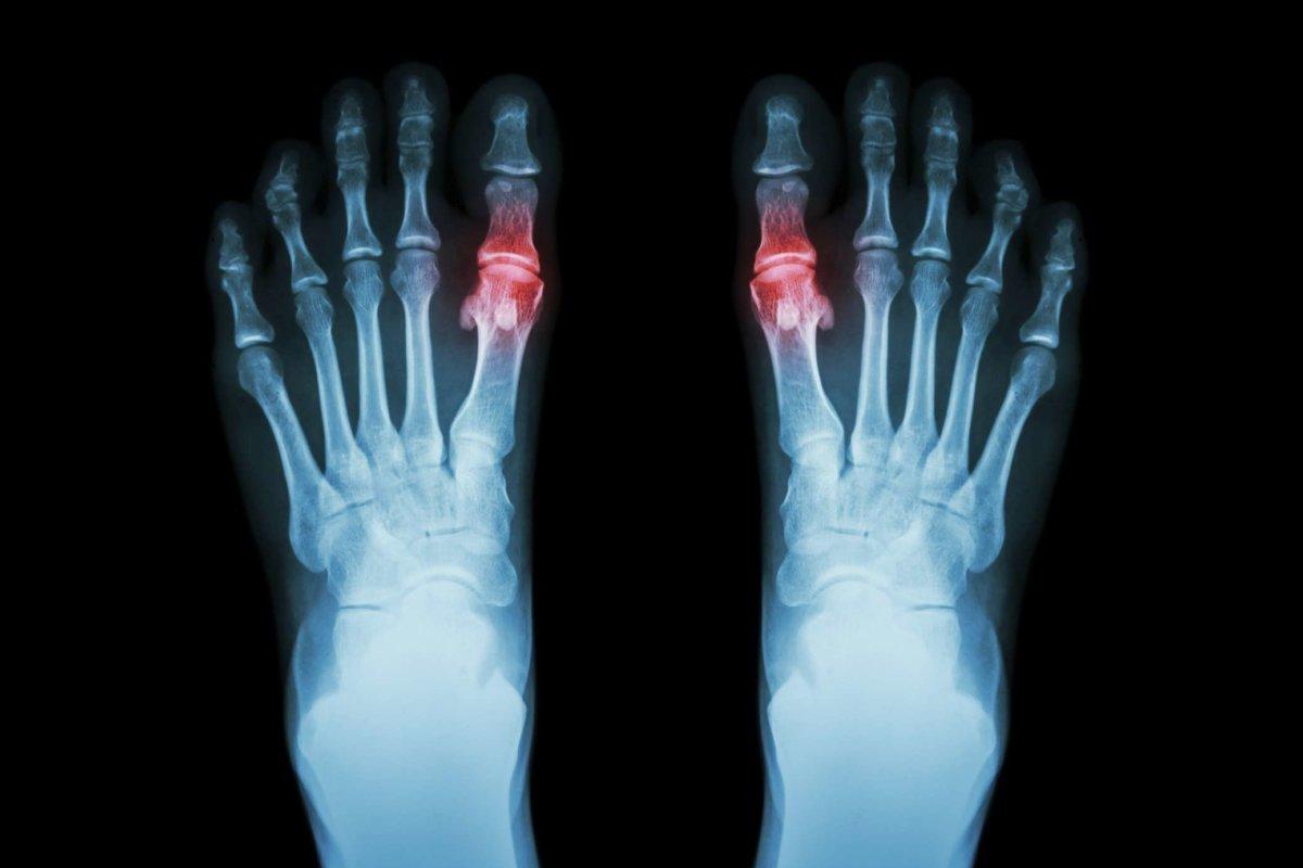 Gout and rheumatoid arthritis