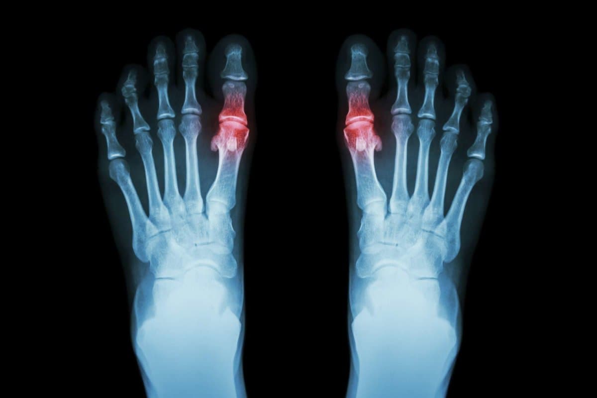 Gicht, rheumatoide Arthritis