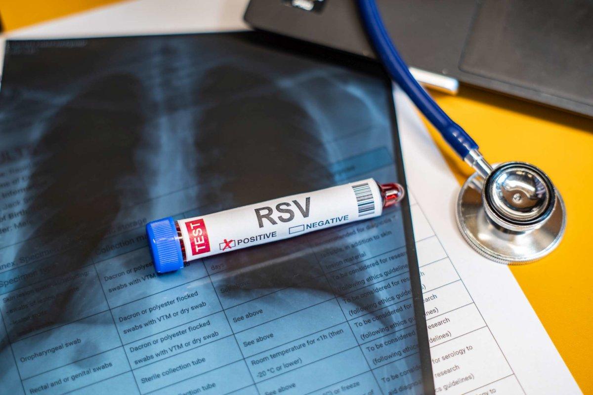 Blutentnahmeröhrchen Respiratory Syncytial Virus (RSV) Test positive Ergebnisse, medizinisches Konzept