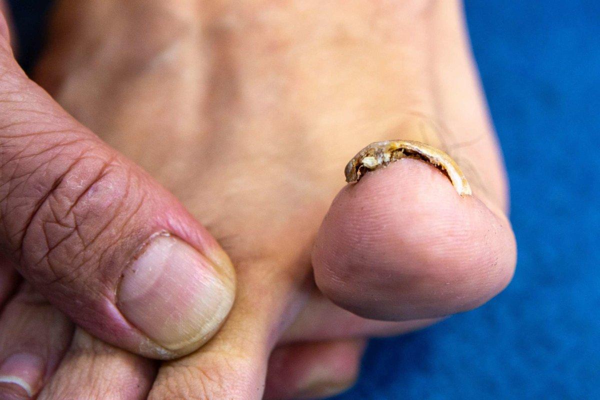 Toe nail with onychomycosis bottom view. Fungal infection that infects keratin. Common mycosis in the human foot