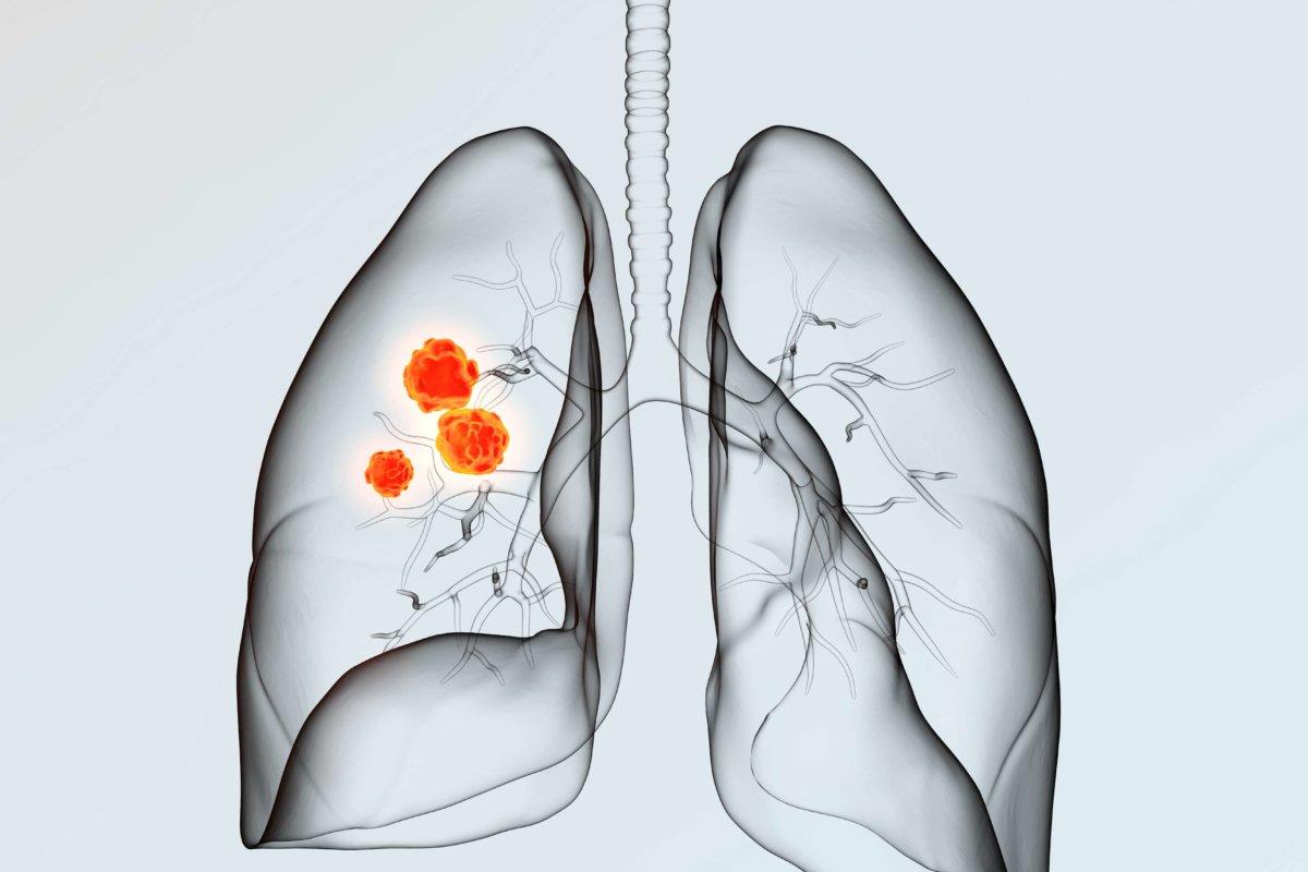 Lung cancer on light background, medically 3D illustration showing red tumor