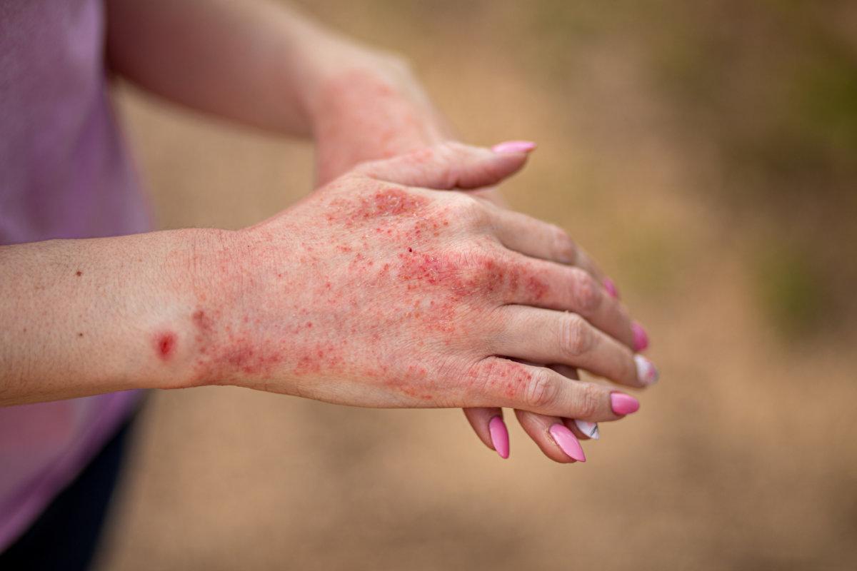 Close up dermatitis on skin, ill allergic rash eczema skin of patient , atopic dermatitis symptom skin detail texture , Fungus of skin ,The concept dermatology, treatment fungal