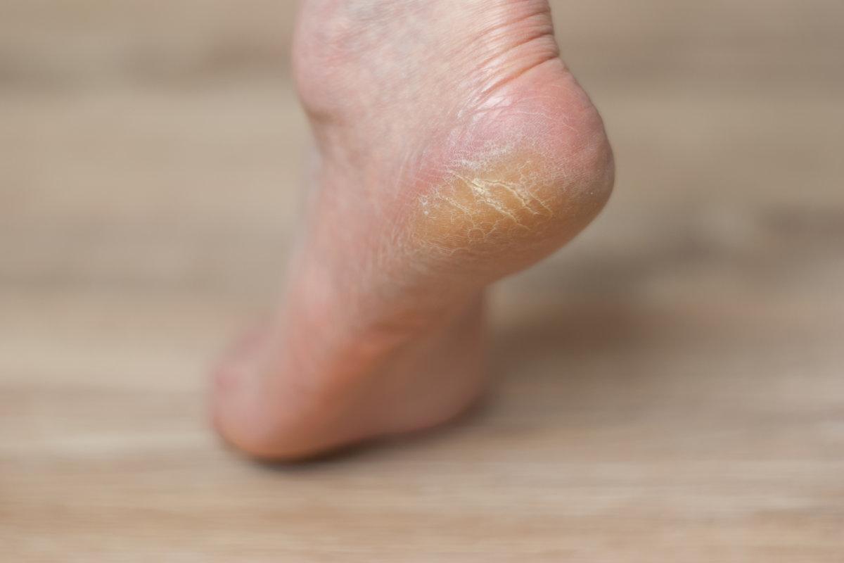 clavus and cracks on the heel of female foot close-up