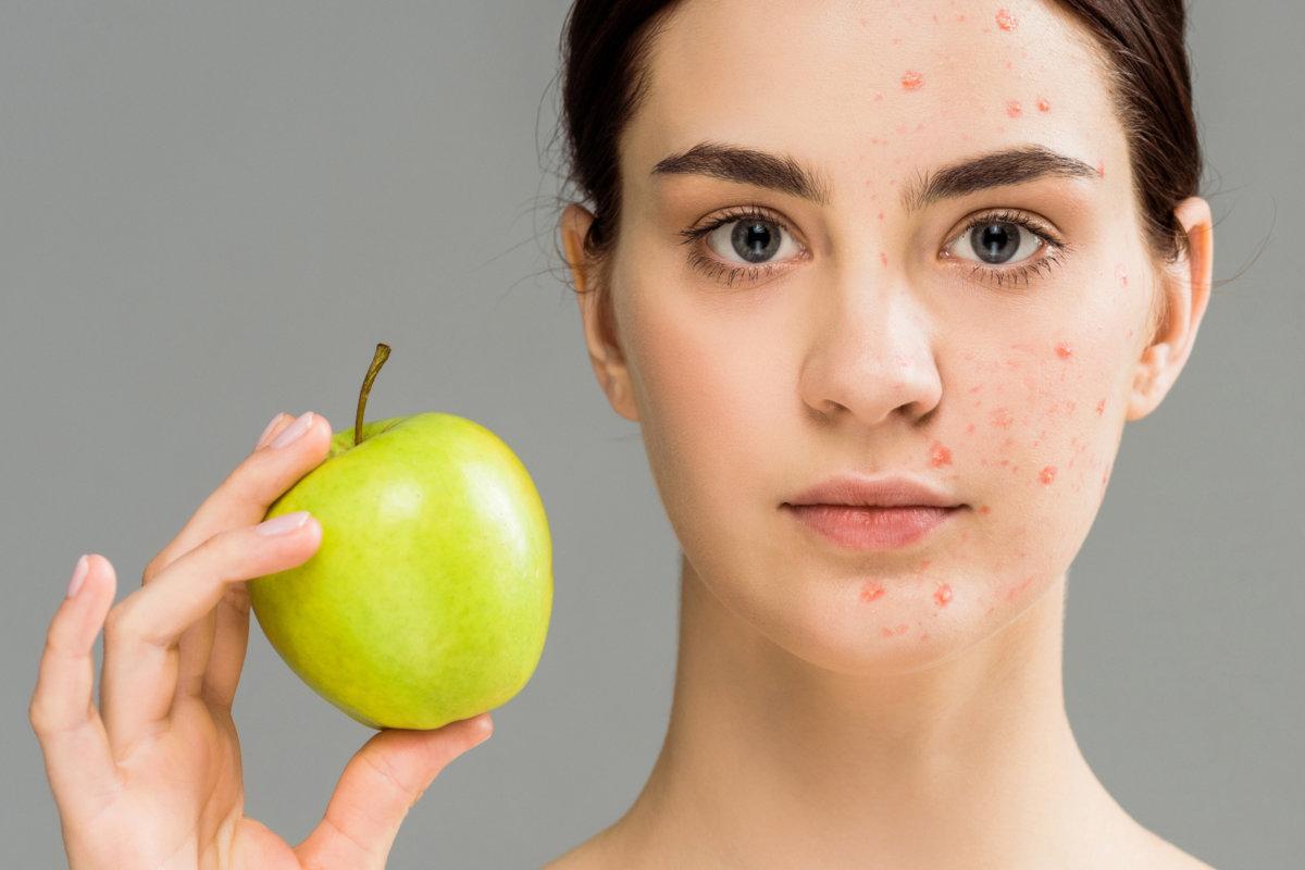 panoramic shot of young woman with acne on face holding green apple isolated on grey