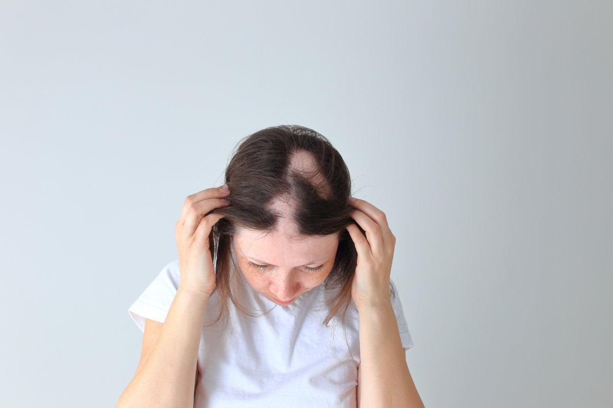 Real alopecia areata in a young girl. A bald head in a person.