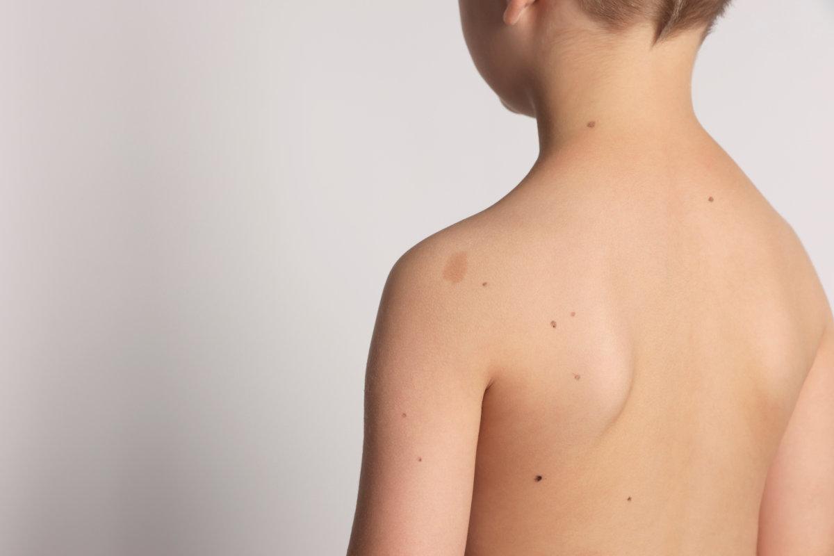 Closeup of boy's body with birthmarks on light grey background, back view. Space for text
