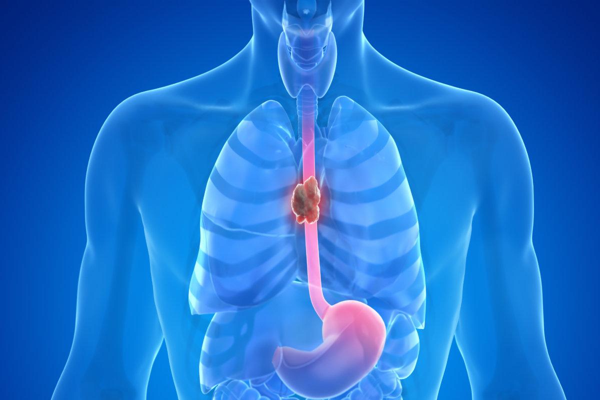 3d rendered medically accurate illustration of esophagus cancer