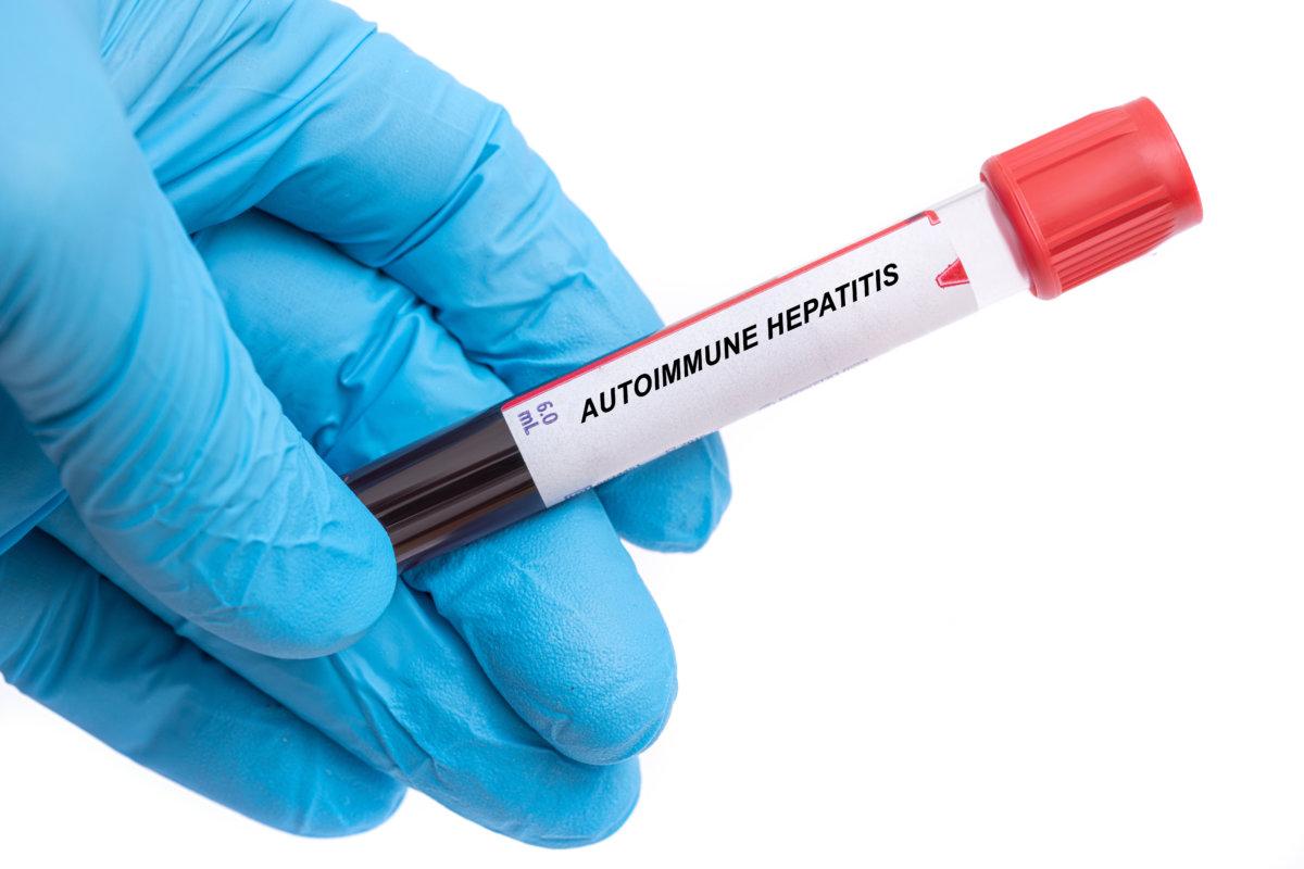 Autoimmune Hepatitis. Autoimmune Hepatitis disease blood test in doctor hand