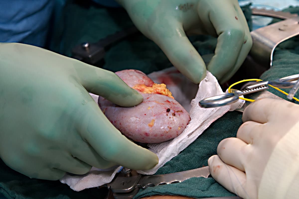 Nierentransplantation26