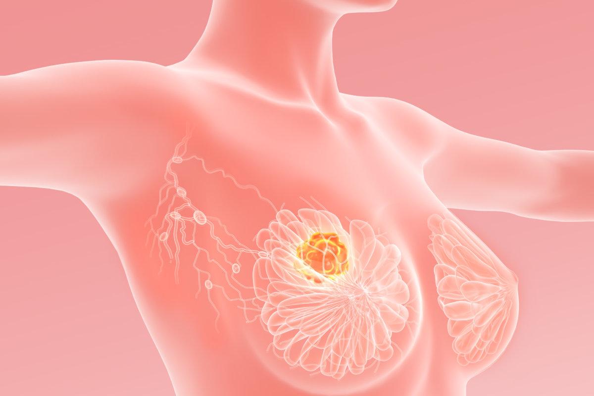 3d illustration shows breast cancer with lymphatics, medically 3D illustration on pink background
