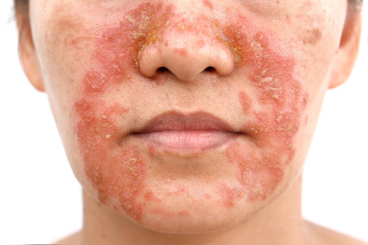 Seborrheic Dermatitis In adult face isolated white background
