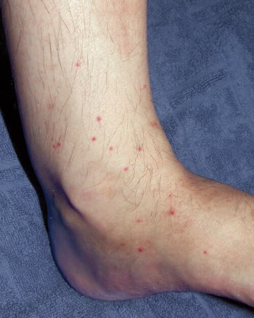 MO_AT_2023_KW51_MTNL_wikimedia_Maslesha_Flea_Bites_to_the_Lower_Leg_of_a_Human_Subject_01