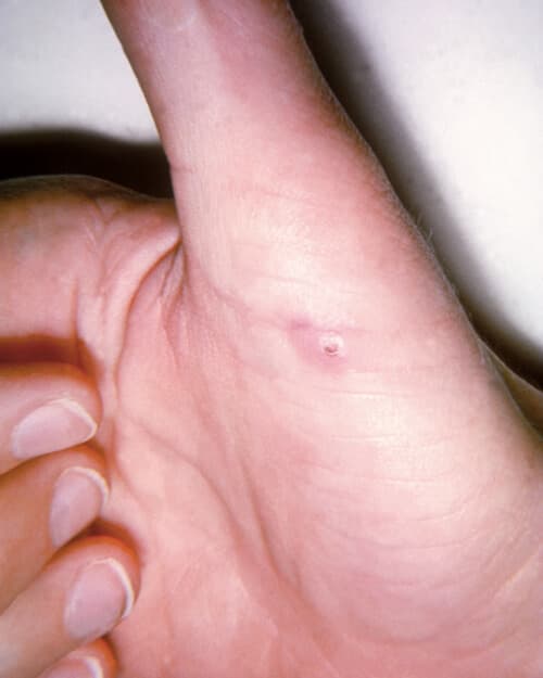 MO_AT_2023_KW51_MTNL_wikimedia_Regardmore_Cat-scratch_disease_lesion_