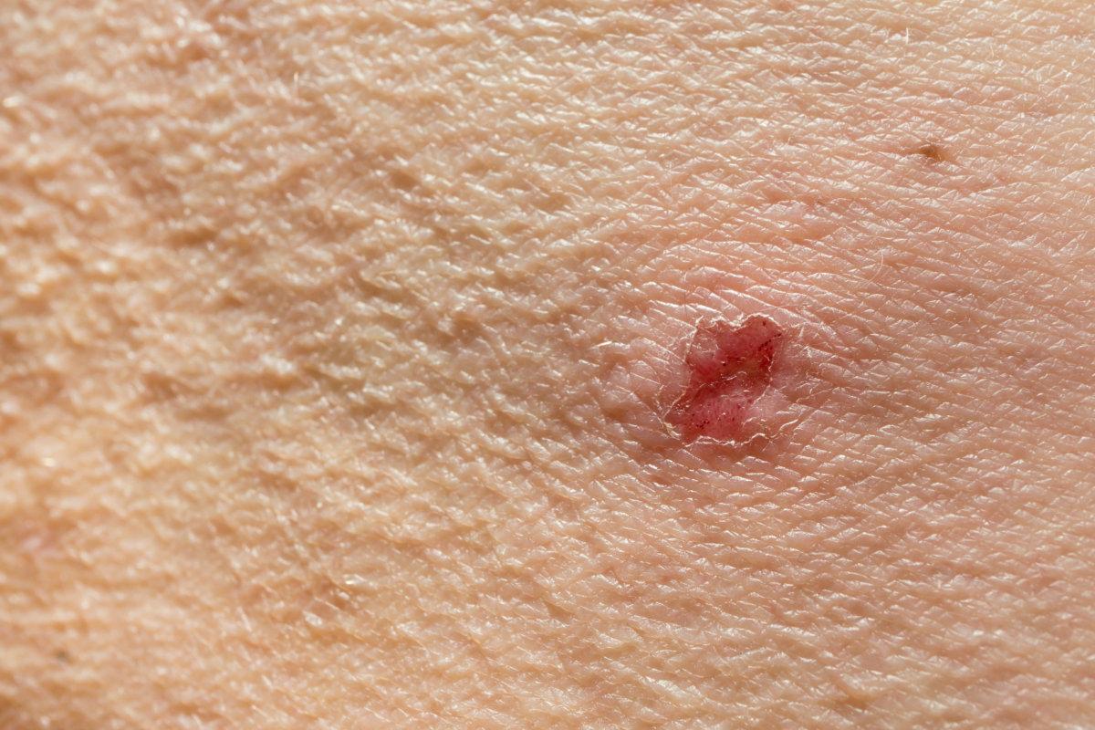 Juckende Haut. Eingerissene Haut an der Entzündungsstelle. Peeling und Kämmen der Haut bei verschiedenen Hauterkrankungen.