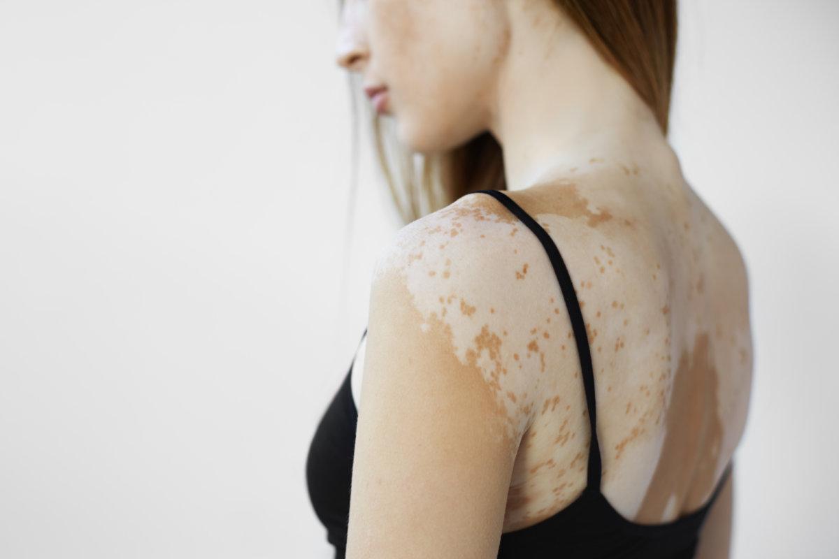 Ausgeschnittene Rückansicht einer schönen jungen Europäerin mit Hautproblemen, die zu Melaninverlust führt, posiert